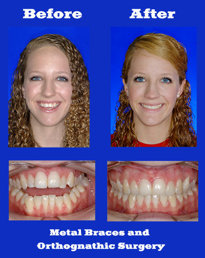 Metal Braces and Orthognathic Surgery